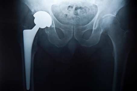 an x-ray of a hip replacement